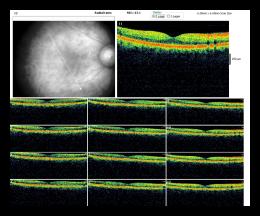 RADIAL LINE OD